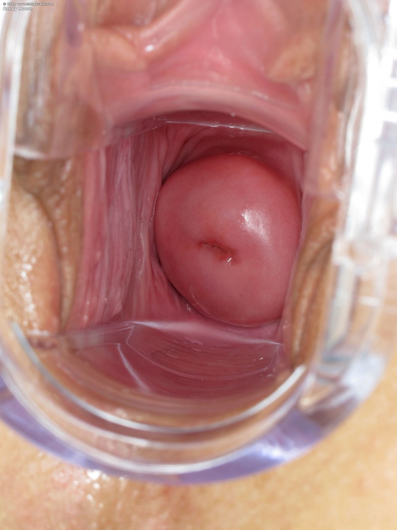 XRAY оплодотворение urethra